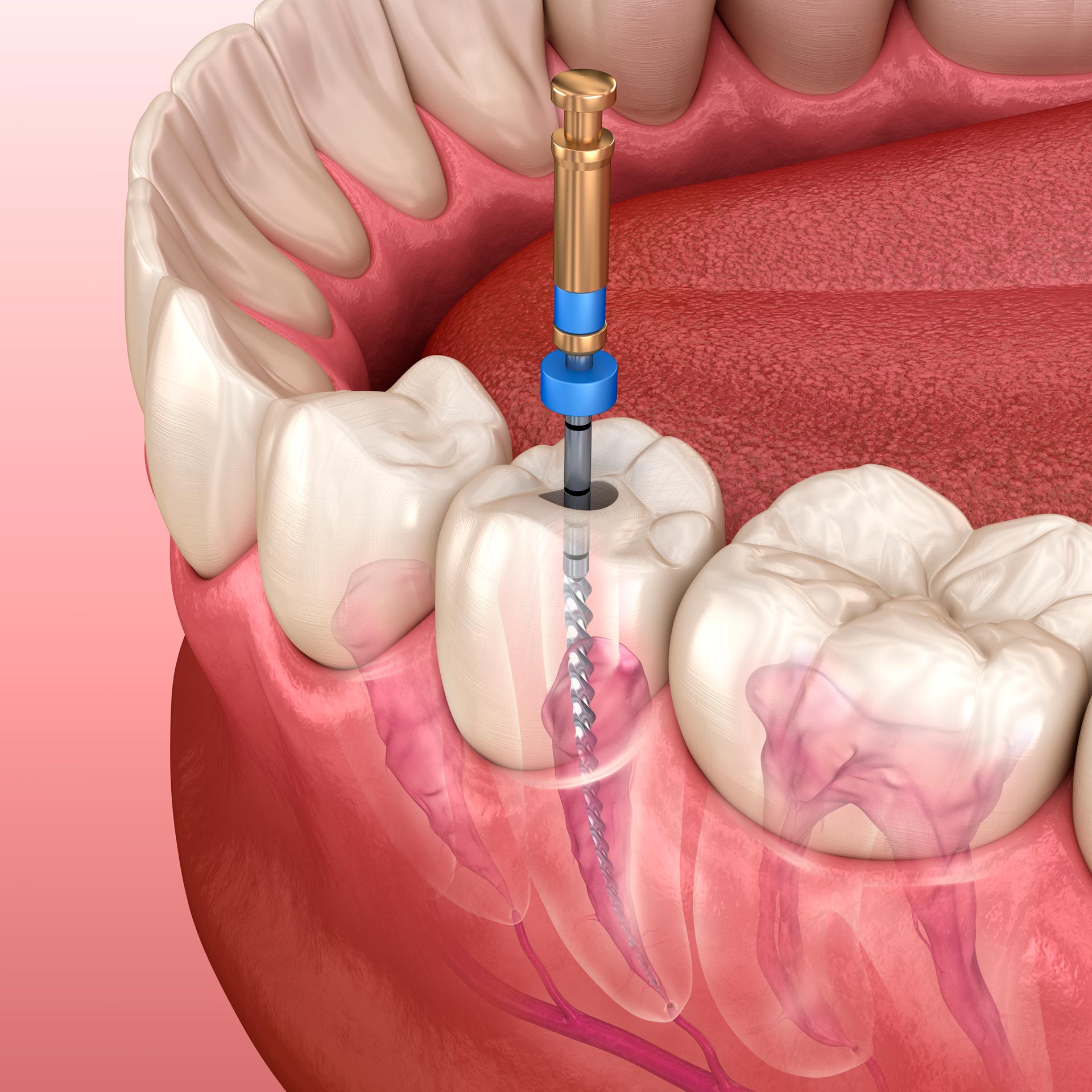 s-endodoncia